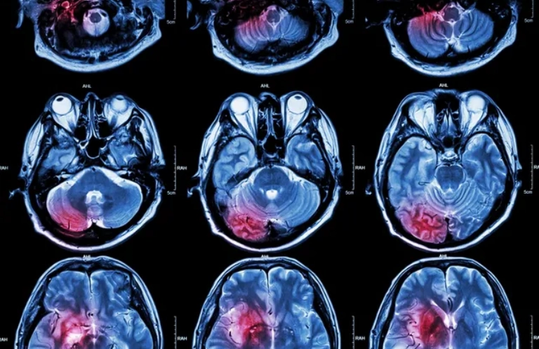 MRI of Brain ( Cross Section of Brain )